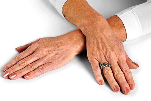 Hand skin with age-related changes that require the use of rejuvenation techniques