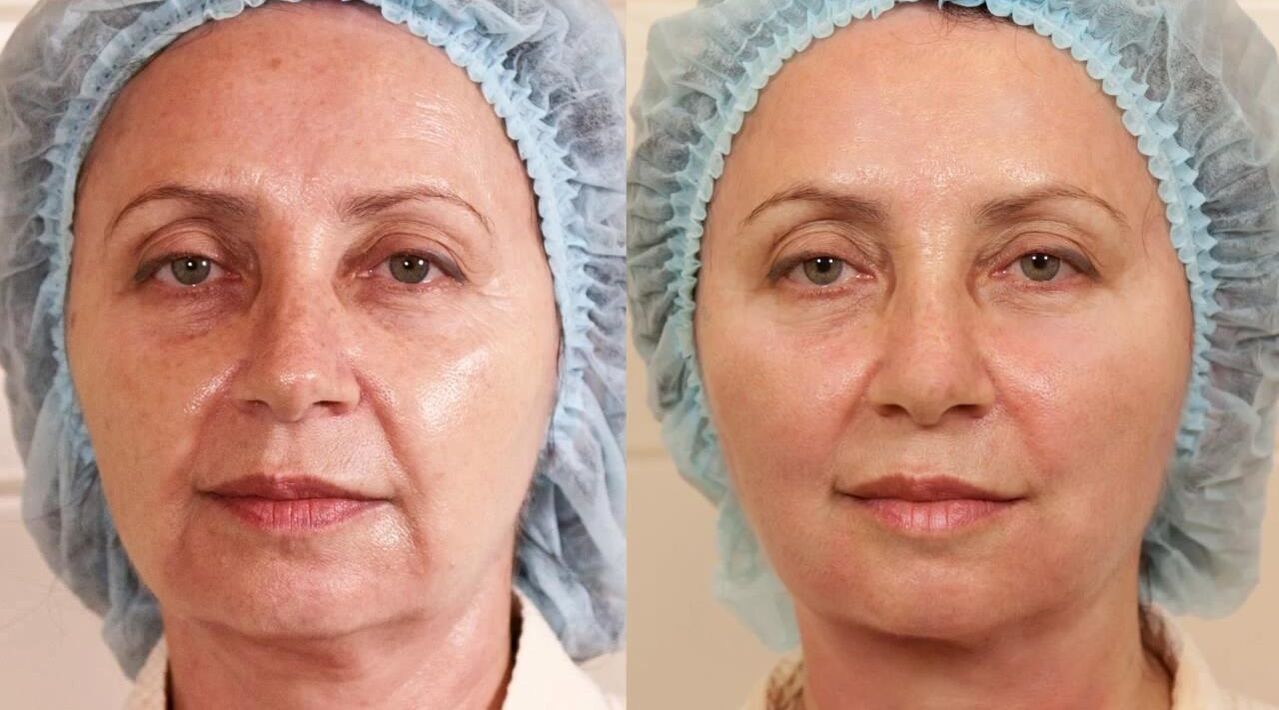 before and after pictures of facelift