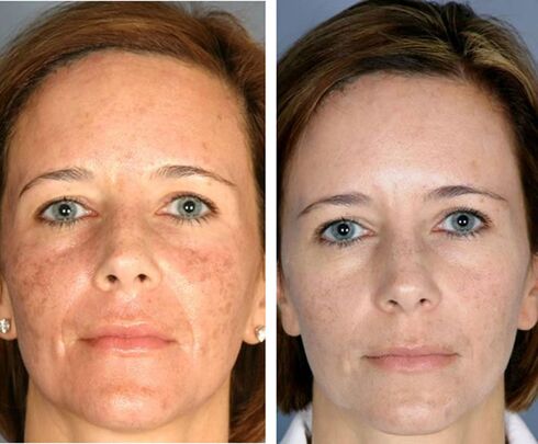 Before and after fractional facial thermolysis