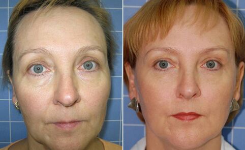 Before and after fractional laser facial rejuvenation