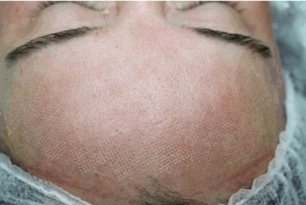 Redness and slight swelling of the skin after fractionated laser