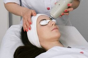 perform the procedure with laser fractional rejuvenation